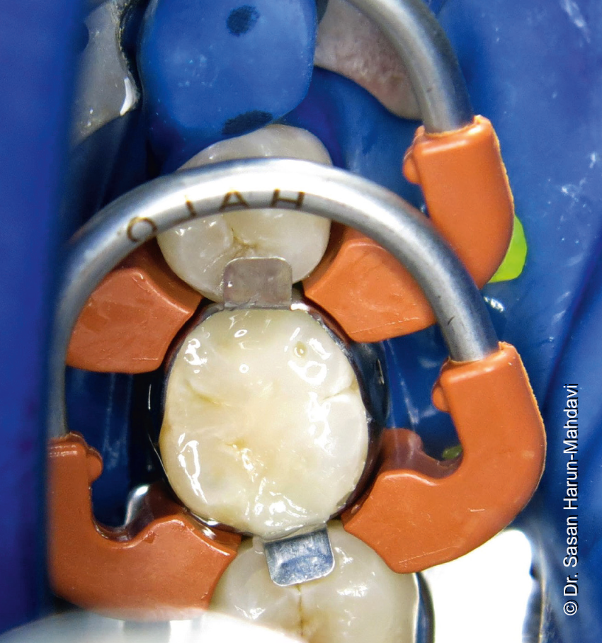 "Very well thoughtout" Review of new sectional matrix system